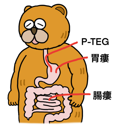 胃瘻、腸瘻、P-TEGのイラスト